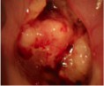 /album/fotogaleria-colposcopia/cancer-avanzado-del-cuello-de-la-matriz1-jpg/